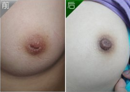 乳头凹陷矫正手术术前注意事项有哪些？