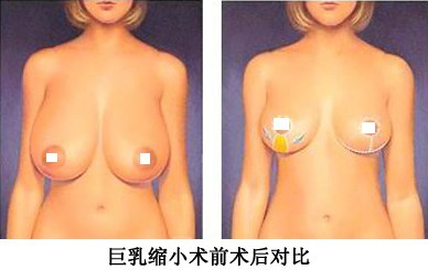 巨乳缩小术会在胸部留下伤疤吗？