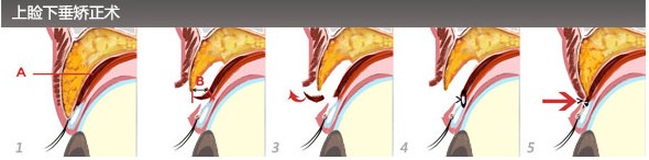 产看更多上眼睑下垂矫正方法《《